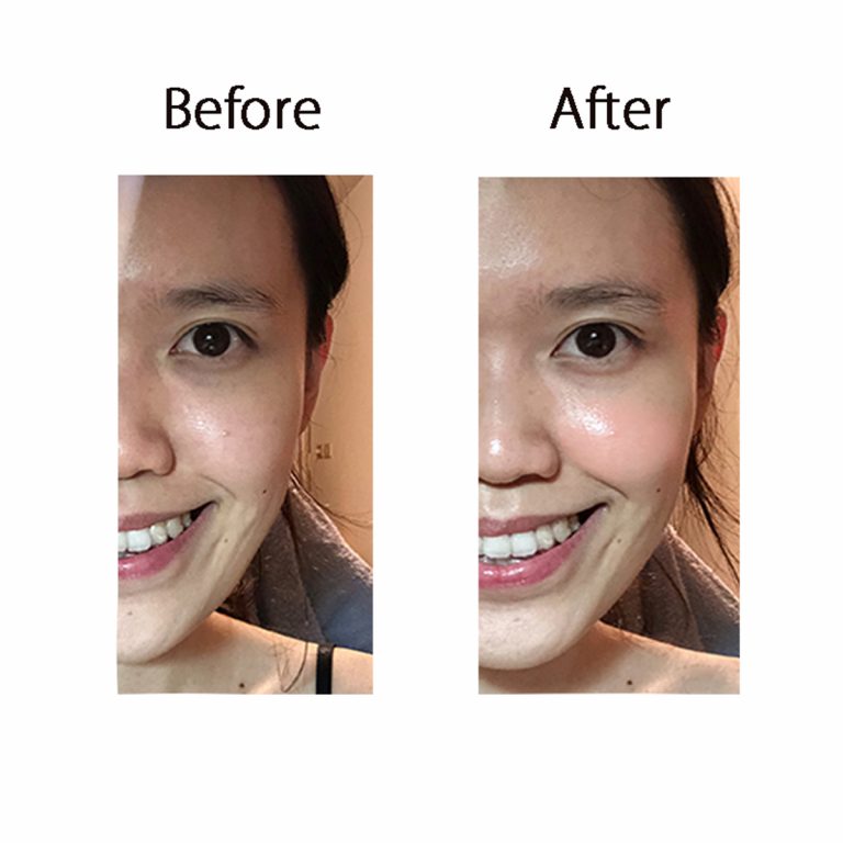 使用CurrentBody Skin LED光療面膜美容儀的前後對比